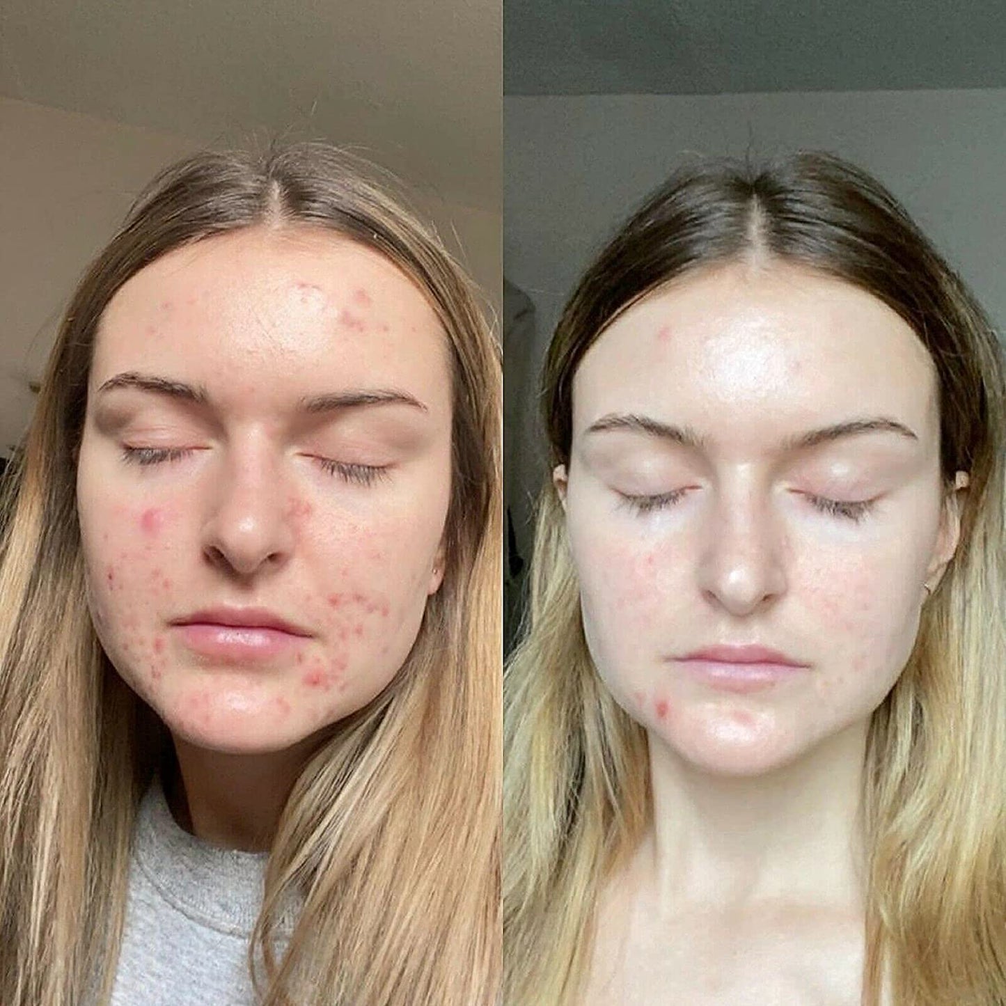 Tretinoin gel 0.1%
