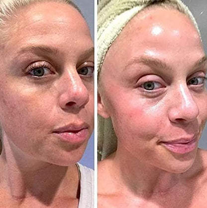 Tretinoin gel 0.1%
