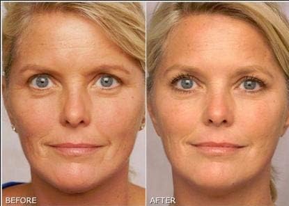 Tretinoin gel 0.1%
